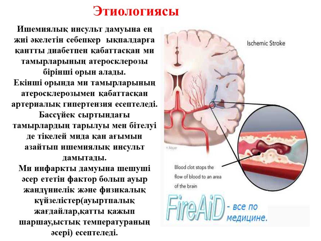 Правосторонний ишемический инсульт головного мозга. Презентация на тему инсульт. Ишемический инсульт презентация.