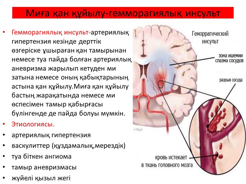 Инсульт органа