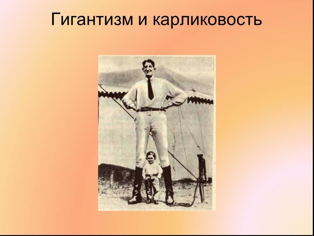 Заболевания связанные с ростом. Акромегалия и гигантизм нанизм. Гигантизм и карликовость. Рисунок гигантизм и карликовость. Железа заболевания гигантизм.