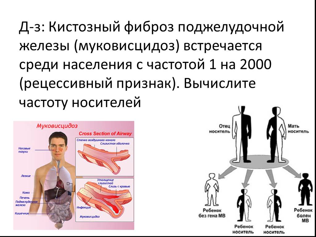 Муковисцидоз презентация генетика