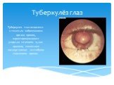 Туберкулёз глаз. Туберкулез глаз относится к тяжелым заболеваниям органа зрения, характеризующимся упорным течением и, как правило, тяжелыми последствиями со стойким снижением зрения.