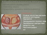 ВПР носа: врожденная атрезия хоан - односторонняя, двухсторонняя - частичная, полная - перепончатая, хрящевая, костная, смешанная. Диагностика: Полное отсутствие носового дыхания на стороне поражения Зондирование носовых ходов Закапывание контрастных веществ в нос Рентгенография КТ