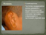 Симптоматика Частично недоразвитая ушная раковина с отсутствующим или очень узким наружным слуховым проходом, сопровождается частичной утратой слуха. IIстепень