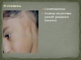 Симптоматика Полное отсутствие ушной раковины (анотия). IV степень