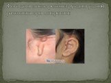 Фото до и после реконструкции ушной раковины при микротии: