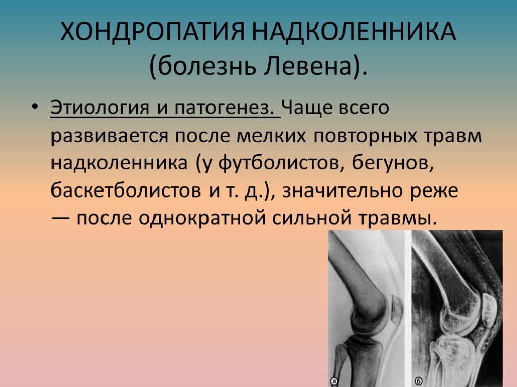 Хондромаляция надколенника что это. Болезнь Левена остеохондропатия надколенника рентген. Надколенник остеохондропатия надколенника. Остеохондропатия надколенника болезнь Ларсена. Болезнь Левена коленного сустава рентген.