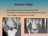 Болезнь Гоффа-. хроническое воспаление жировой клетчатки в области крыловидных складок тела Гоффа коленного сустава.