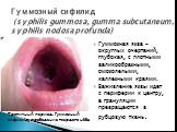 Гуммозная язва - округлых очертаний, глубокая, с плотными валикообразными, омозолелыми, каллезными краями. Заживление язвы идет с периферии к центру, а грануляции превращаются в рубцовую ткань. Гуммозный сифилид (syphilis gummosa, gumma subcutaneum, syphilis nodosa profunda). Третичный период. Гуммо