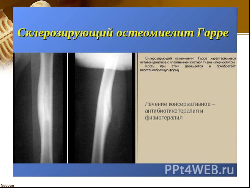 Рентгенодиагностика остеомиелита презентация