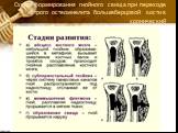 Схема формирования гнойного свища при переходе острого остеомиелита большеберцовой кости в хронический