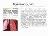 Муковисцидоз. Муковисцидоз (кистозный фиброз) – это наследственное заболевание, обусловленное поражением желез внешней секреции (слюнные железы, потовые железы, поджелудочная железа) и усиленной продукцией густой и вязкой слизи. Муковисцидоз легких - клинический вариант системного муковисцидоза, про