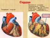 Сердце Здоровое сердце. Произошло жировое перерождение. Сердце увеличено в объеме (иногда в 1,5-2 раза). Развивается сердечная недостаточность. Жировая ткань