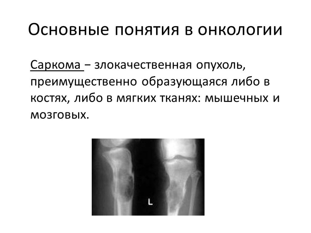 Саркома анализы. Злокачественная опухоль кости. Злокачественная саркома.