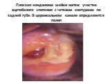 Плоская кондилома шейки матки: участки ацетобелого эпителия с четкими контурами по задней губе. В цервикальном канале определяется полип