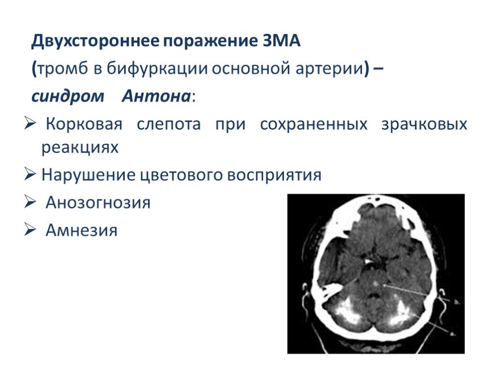 Тромбоз артерий мозга. Инсульт в бассейне средней мозговой артерии клиника. Ишемический инсульт поражения артерий. ОНМК В задней мозговой артерии симптомы. Ишемический инсульт в бассейне средней мозговой артерии.