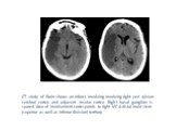 CT study of Brain shows an infarct involving involving right peri sylvian cerebral cortex and adjacent insular cortex. Right basal ganglion is spared. Area of involvement corresponds to right MCA distal main stem (superior as well as inferior division) territory.