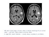 MRI Axial FLAIR images of brain shows an infarct involving left pre central cortex - a left MCA cortical branch occlusion infarct. A single MCA branch infarction is nearly always secondary to an embolus.