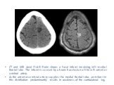 CT and MRI Axial FLAIR Brain shows a focal infarct involving left medial frontal lobe. The infarct is caused by a branch occlusion of the left anterior cerebral artery. As the anterior cerebral artery supplies the medial frontal lobe, an infarct in this distribution predominantly results in weakness