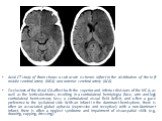 Axial CT study of Brain shows a sub acute ischemic infarct in the distribution of the left middle cerebral artery (MCA) and anterior cerebral artery (ACA). Occlusions of the distal ICA affect both the superior and inferior divisions of the MCA, as well as the lenticulostriates, resulting in a contra