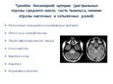 Тромбоз базилярной артерии (ростральные отделы среднего мозга, часть таламуса, нижние отделы височных и затылочных долей). Различные нарушения иннервации зрачков Птоз или лагофтальм Парез вертикального взора Сонливость Гемибаллизм Амнезия Корковая слепота