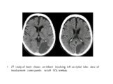 CT study of brain shows an infarct involving left occipital lobe. Area of involvement corresponds to left PCA territory.