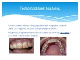 Гипоплазия эмали –недоразвитие твердых тканей зуба , в период их роста и формирования. Крайним выражением гипоплазии является аплазия – полное отсутствие эмали. Гипоплазия эмали.