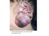Мукоэпидермоидный рак околоушной слюнной железы