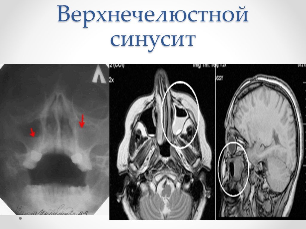 Верхнечелюстной синусит. Острый верхнечелюстной синусит кт. Одонтогенный гайморит мрт. Кт верхнечелюстной пазухи. Мрт околоносовых пазух гайморит.