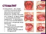 Стоматит. Стоматит – это общее понятие воспалительных заболеваний слизистой оболочки полости рта. Возникает данная патология, как правило, на фоне общего и локального снижения иммунитета. В зависимости от причины возникновения, различают следующие виды стоматита: • Хронический рецидивирующий афтозны