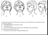 Направление разрезов кожи лица и шеи для вскрытия абсцессов и флегмон челюст­но-лицевой области: А — подподбородочной и подчелюстной; Б — дна полости рта; В — височ­ной, подвисочной, позадичелюстной областей, верхней губы, крылочелюстного пространства; Г — височной, жевательной, околоушной областей