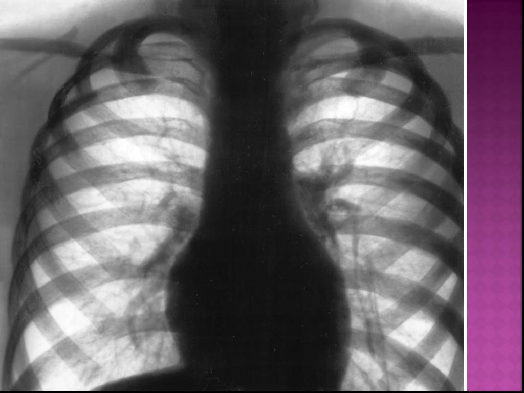 Диффузный пневмосклероз это рак. Диффузный пневмосклероз. Диффузный пневмосклероз рентгенограмма. Пневмосклероз легких это на рентгене лёгких.