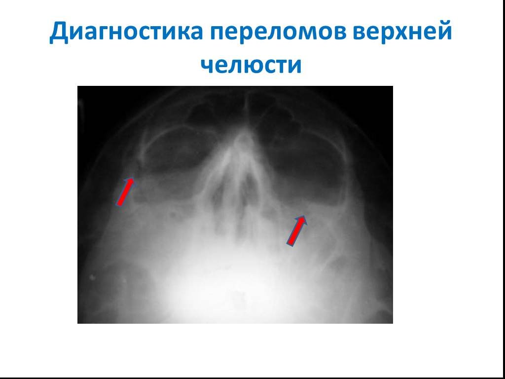 Диагноз трещина. Перелом верхней челюсти диагностика. При переломе верхней челюсти диагностируется. Перелом верхней челюсти рентген. Перелом кости верхней челюсти.