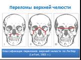 Переломы верхней челюсти. Классификация переломов верхней челюсти по Ле Фор (Le Fort, 1901 г.)
