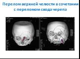 Перелом верхней челюсти в сочетании с переломом свода черепа