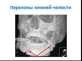 Переломы костей черепа Слайд: 37