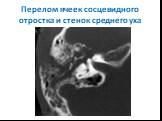 Перелом ячеек сосцевидного отростка и стенок среднего уха