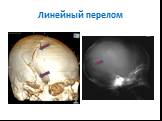 Переломы костей черепа Слайд: 6
