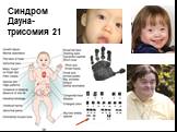 Синдром Дауна- трисомия 21