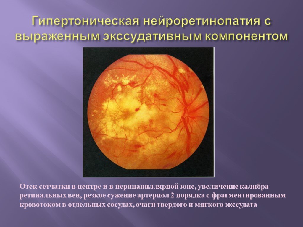Изменение на глазном дне. Гипертоническая ретинопатия сетчатки. Гипертоническая ангиопатия и ретинопатия. Гипертоническая ретинопатия глазное дно. Гипертоническая ангиопатия сетчатки глазное дно.