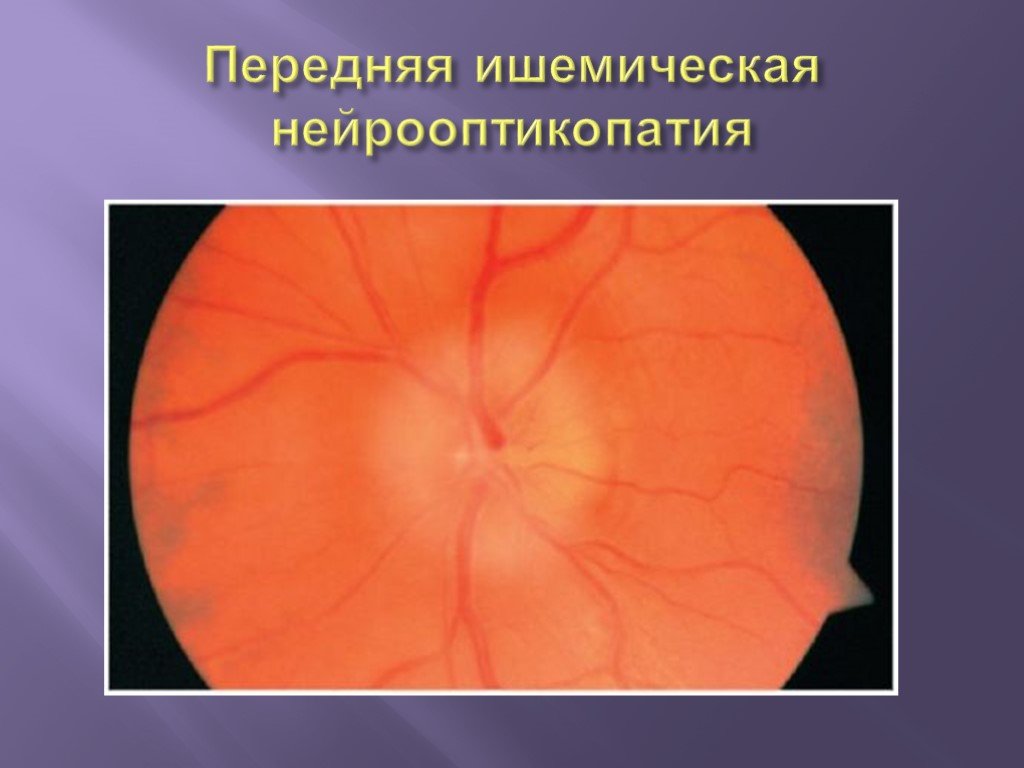 Передняя ишемическая нейропатия. Нейрооптикопатия зрительного нерва. Передняя ишемическая нейропатия глазное дно. Ишемическая оптикопатия зрительного нерва. Ишемическая нейропатия глазное дно.