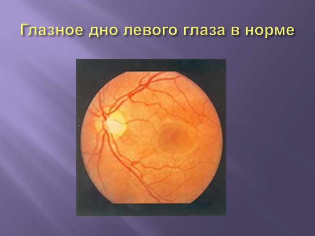 Норма глазного дна. Глазное дно норма офтальмология. Псевдомембрана глазное дно. Нанофтальм глазное дно.