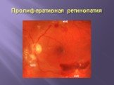 Пролиферативная ретинопатия