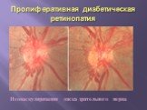 Пролиферативная диабетическая ретинопатия. Неоваскуляризация диска зрительного нерва