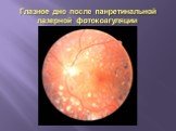 Глазное дно после панретинальной лазерной фотокоагуляции