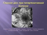 Глазное дно при гипертонической болезни. Сужение ретинальных артерий 3 порядка (стрелки). Симптом перекреста на верхневисочной ветви центральной вены сетчатки.
