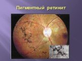 Пигментный ретинит