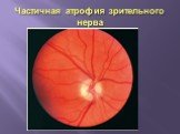 Частичная атрофия зрительного нерва