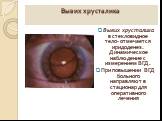 Вывих хрусталика. Вывих хрусталика в стекловидное тело- отмечается иридоденез. Динамическое наблюдение с измерением ВГД. При повышении ВГД больного направляют в стационар для оперативного лечения