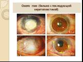 Ожоги глаз (бельмо с последующей кератопластикой)