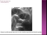 Обзорная рентгенограмма брюшной полости. Симптом перистости (растянутой пружины).
